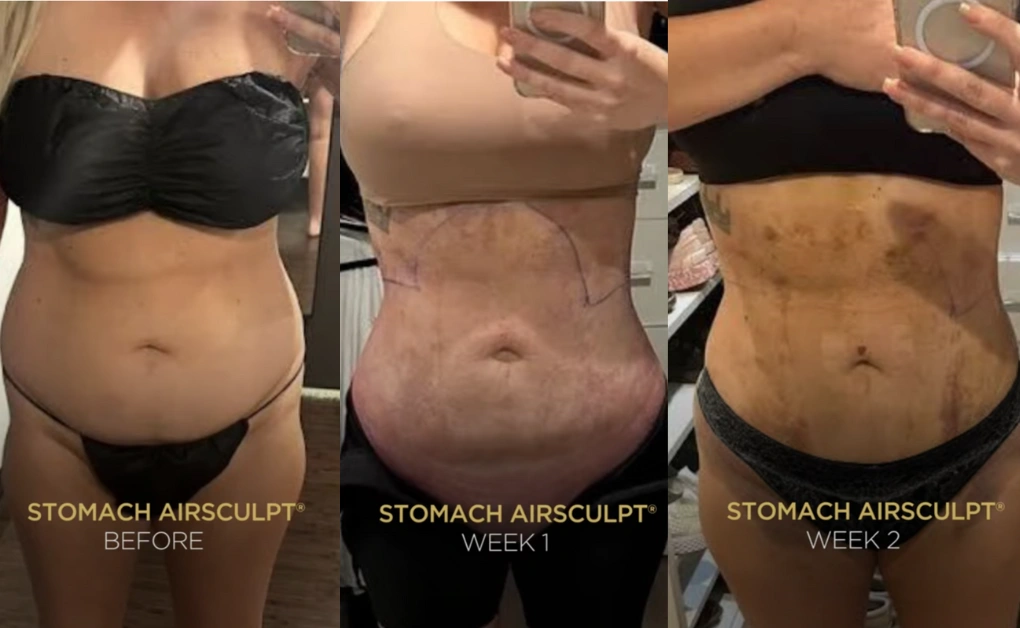 airsculpt results