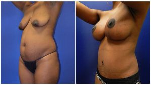 Fat Transfer Breast Augmentation Denver