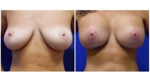 Results after breast Augmentation