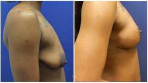 Who is a Candidate for Fat Transfer Breast Augmentation