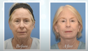before and after 